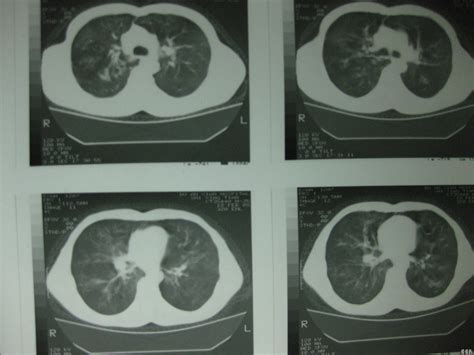 求病友朋友帮忙看下ct报告-肺癌康复圈-觅健