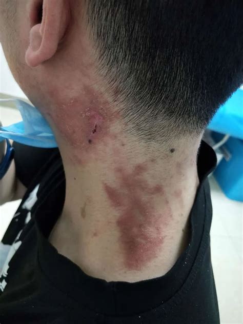小脓包图片