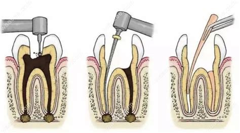 长沙市口腔医院根管治疗多少钱？一颗根管治疗的收费明细 - 口腔资讯 - 牙齿矫正网