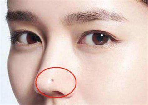 鼻子审美（十三）-男女鼻整形的差异 - 知乎