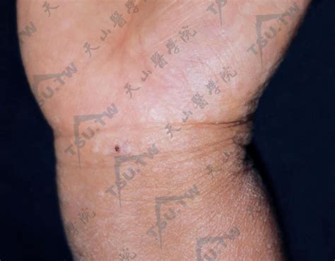 【附图】 腕部及拇指掌侧缘见多数小圆形角化性丘疹 _皮肤病学 | 天山医学院