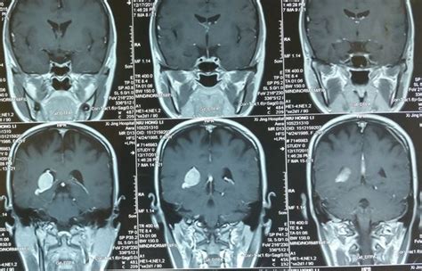 脑肿瘤术后出血的原因及防治 - 脑医汇 - 神外资讯 - 神介资讯