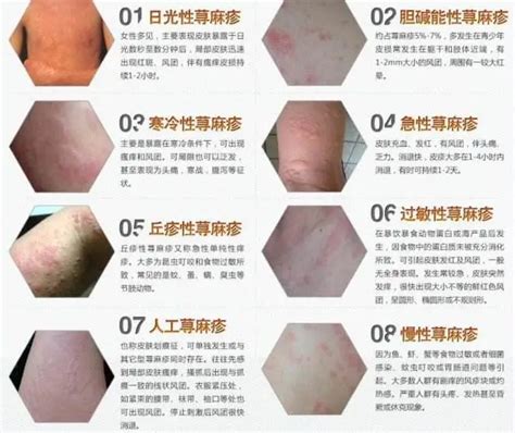 南京治疗荨麻疹最快最好是哪个医院 - 南京华肤皮肤病医院