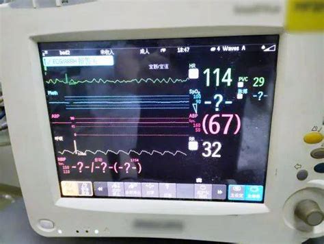 室颤的心电图特点,房颤的心电图特点,室颤心电图3大特点_大山谷图库