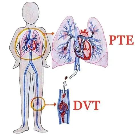 呼吸内科VTE的预防和护理ppt课件_卡卡办公