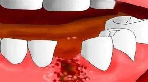 牙髓炎的症状有哪些？_杭州上扬口腔医院