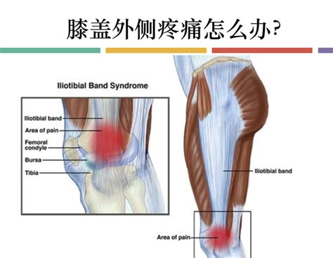 你的“膝盖痛”是怎么回事？