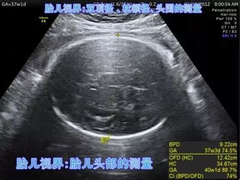 胎儿第四次超声：生长发育检测 (Interval Growth Ultrasound, IGU ) - 知乎