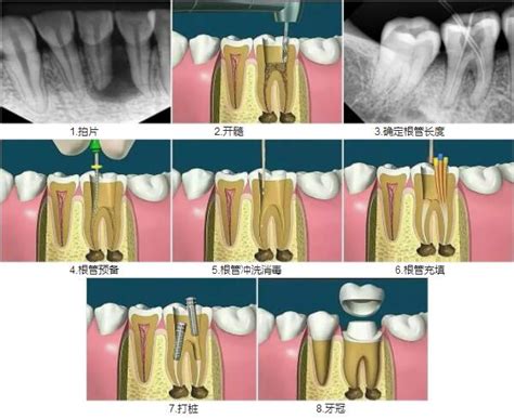 牙齿做根管治疗的步骤和费用_360新知