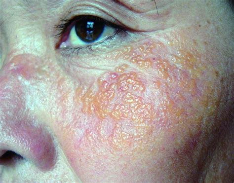 多图慎点！10 组易混淆的皮肤病，你能分辨么？