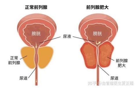 论文报道：前列腺增生动脉栓塞术优势突出，“一根细丝”解决前列腺增生 - 知乎