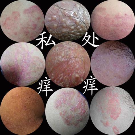 阴囊结节图片