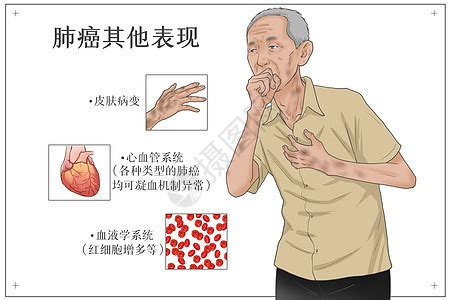 肺癌发展阶段医疗插画插画图片下载-正版图片401803157-摄图网
