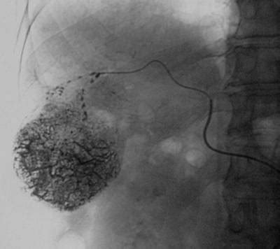 刘振军：开创三门峡首例经颈动脉入路脑巨大动脉瘤介入栓塞术-大河网