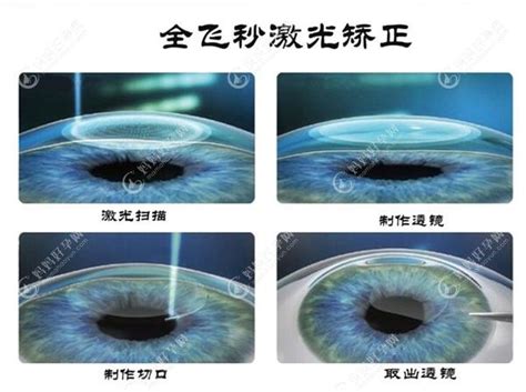 杭州爱尔眼科近视手术价格一览表(飞秒12800+/晶体植入30000+)-生活百科-妈妈好孕网