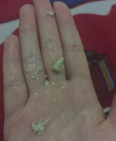 有炎症的白带图片