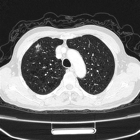 一例表现为双肺多发实变影的免疫功能正常宿主肺隐球菌病-学术-呼吸界