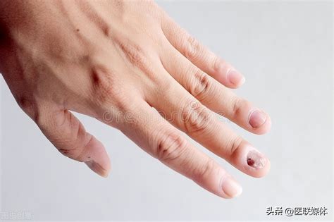 灰指甲相互传染，各甲之间传染是什么原因，中医如何辨证治疗？_凤凰网健康_凤凰网