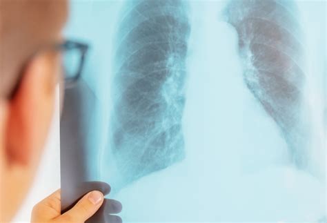 深度：肺癌早筛到底有多重要？早诊早治5年生存率可提高10倍 - 知乎