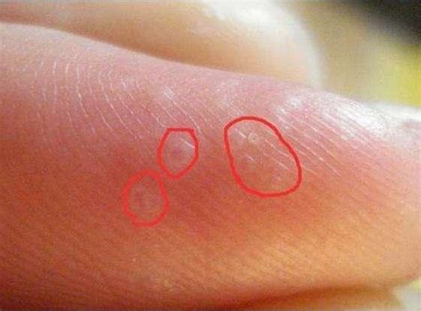 手上长这种小水泡，是身体在给你发信号，要注意了！|水泡|汗疱疹|粟粒_新浪新闻