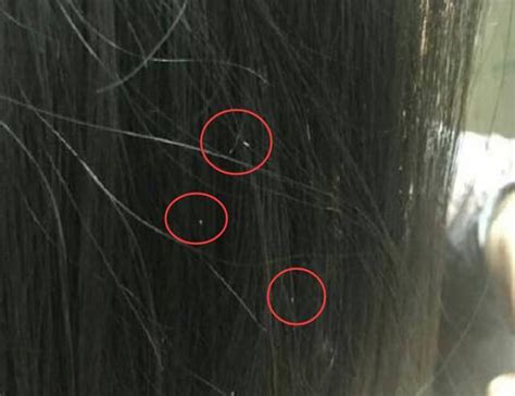 小白点头虱卵图片