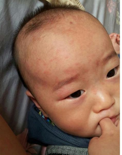 水痘的7天演变过程图片，红色斑疹丘疹到疱疹结痂(15天痊愈) — 神奇养生网