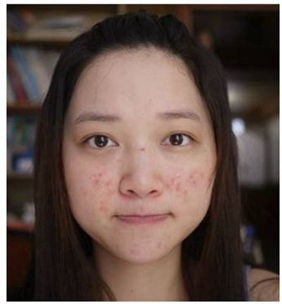 女人脸上长痘痘是什么原因_39健康经验