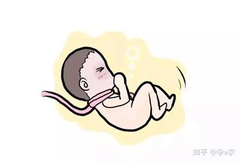 “淘气”宝宝脐带绕颈6周，生死时速紧急剖宫产保母婴平安 - 知乎