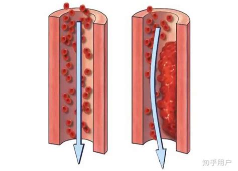 人造血管是用什么材料造的？怎么保证与人体自身血管紧密结合，不会渗漏吗？ - 知乎