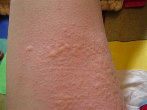 荨麻疹日常生活注意事项有哪些-长春博润皮肤病医院