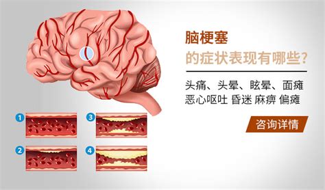 出现这些症状 要警惕脑梗塞_上海蓝十字脑科医院官网_同济大学附属脑科医院（筹）