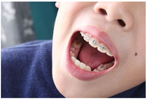 近500倍提升效率！Nature 子刊发布「AI 牙分割」最新研究成果_牙齿_数字化_口腔