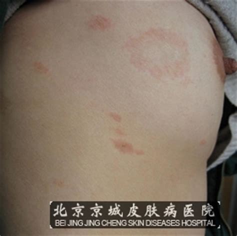 玫瑰糠疹和梅毒的关系_玫瑰糠疹_北京京城皮肤医院(北京医保定点机构)