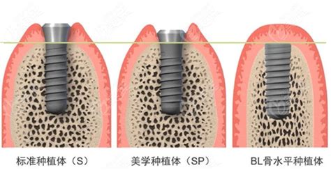 半口半固定种植牙怎样摘戴?看完种植流程你就知道了巨简单,种植牙-8682赴韩整形网