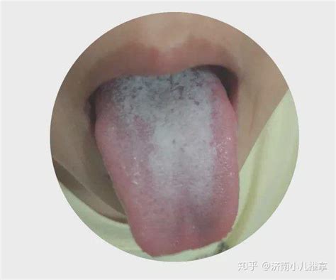 小儿积食舌苔图片