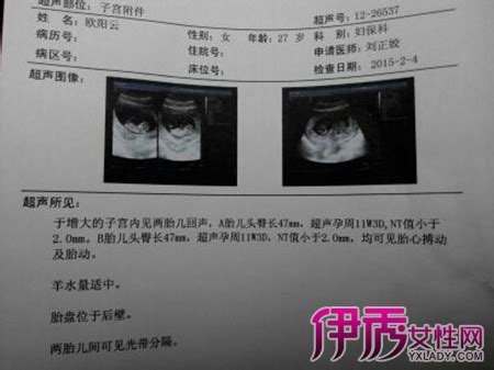 早孕b超单子图片