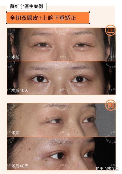 南京割双眼皮好的医院医生功课，案例图和详细价格表一览 - 爱美容研社