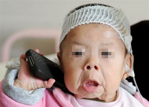 郑州1岁半儿童满脸皱纹酷似老太_第一金融网
