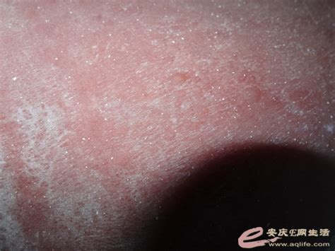 【水泡图片】【图】皮肤起水泡图片 几种皮肤水泡的处理方法(2)_伊秀健康|yxlady.com