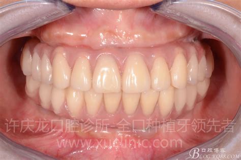 案例解析（二）高效的全口种植牙方案All-on-4-许庆龙医生Dr.Xu的博客-KQ88口腔博客