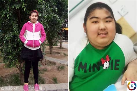 13岁女孩为治病吃成201斤胖子，为省钱救命，半年又减掉77斤__凤凰网
