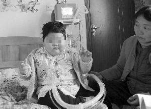 5岁女童患怪病半年增34斤 多次被下病危通知书——人民政协网