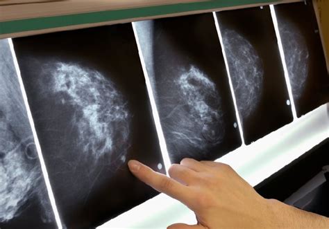 世界乳腺癌宣传日 | 做健康女性，从预防乳腺癌开始_健康界