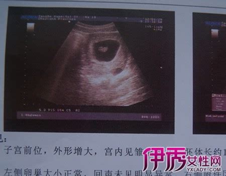 【怀孕b超图片一个月】【图】揭秘怀孕b超图片一个月 9步教你如何看懂b超图_伊秀亲子|yxlady.com