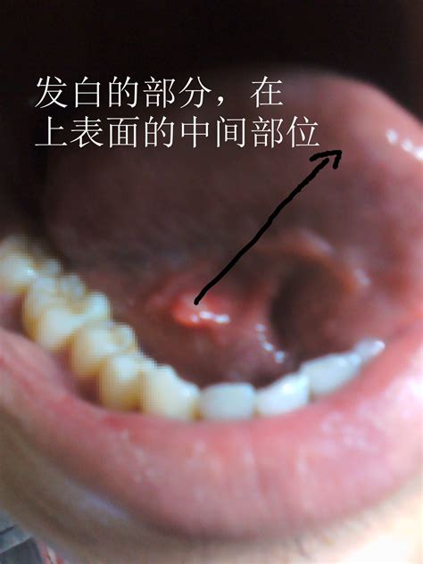 舌癌的早期症状图片 (2)_有来医生
