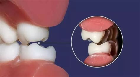 三例上颌磨牙颊侧倾斜引起正锁颌的矫治策略-正畸刘洪杰的博客-KQ88口腔博客