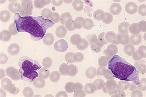 图112 幼稚型异型淋巴细胞(Ⅲ型)-血液学细胞学-医学