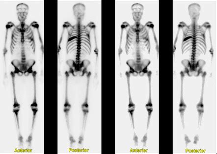 Superscan | Radiology Reference Article | Radiopaedia.org