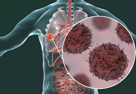 肺癌发病率居我国首位，诊疗新技术将肺癌变为慢性病 - 活动回顾 - 健康时报网_精品健康新闻 健康服务专家