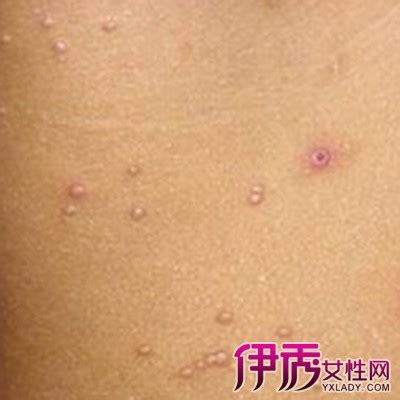 尖锐湿疣女图片